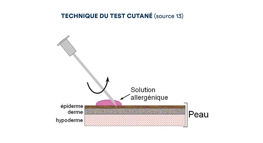 Technique du test cutané (source 13)