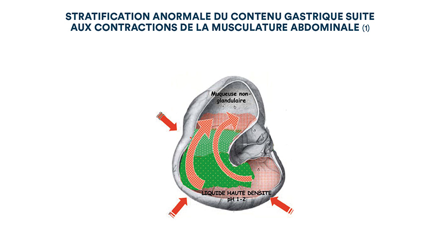 Stratification anormale du contenu gastrique suite aux contractions de la musculature abdominale (1)