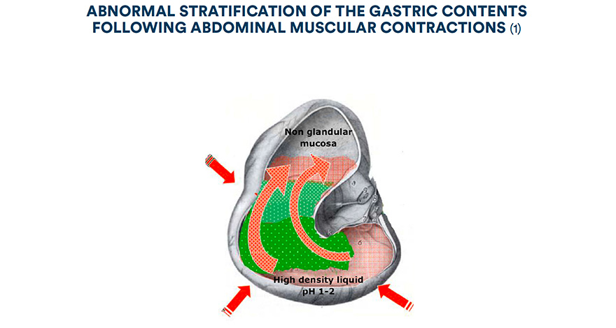 Abnormal stratification of the gastric contents following abdominal muscular contractions